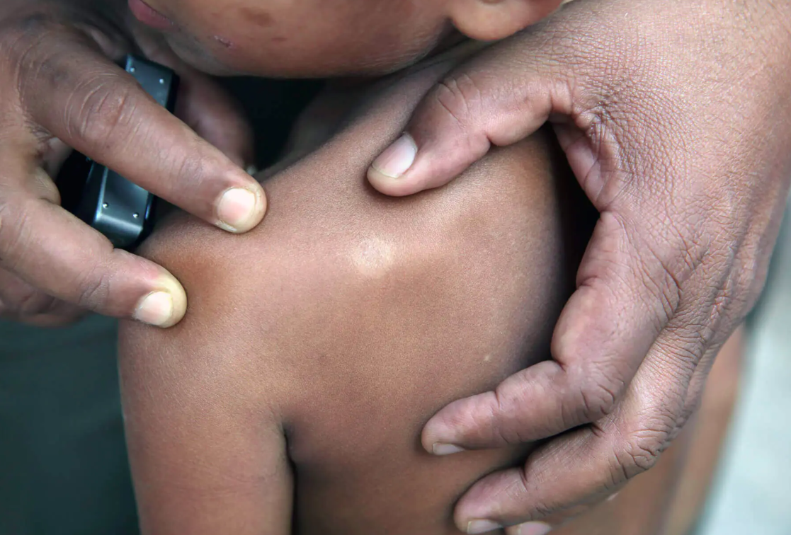 Understanding Leprosy: Its History, Current Challenges, and Path Forward in Nigeria